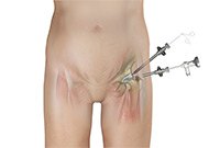 Hip Arthroscopy