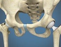 Partial Hip Replacement