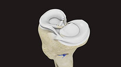 Meniscal Repair Surgery