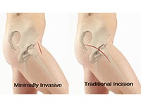 Minimally Invasive Total Hip Replacement