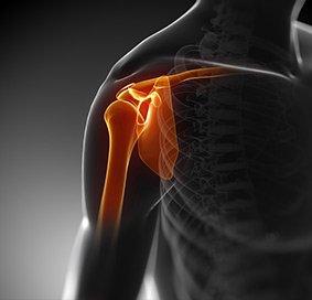 Shoulder Subluxation