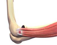 Tennis Elbow Surgery